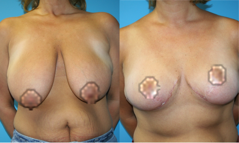 Breast Augmentation Before and After